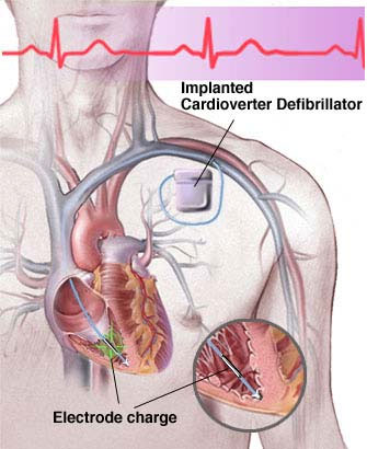 AICD Implantation