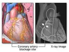 Coronary Angiography