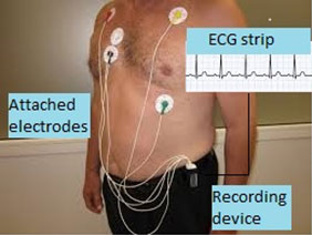 Holter Monitoring