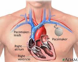 Permanent Pacemaker Implantation